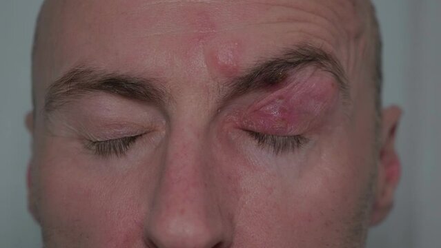 Man with painful shingles virus. Lumps and blisters on his face, head and above his eye. 
