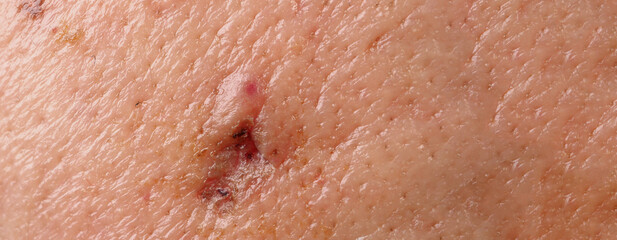 Scars from facial abscess or big acne surgery.  Scars from inflammation of the skin after medical...