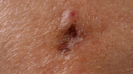 Scars from facial abscess or big acne surgery.  Scars from inflammation of the skin after medical...