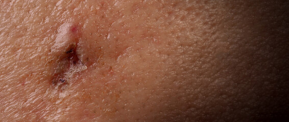 Scars from facial abscess or big acne surgery.  Scars from inflammation of the skin after medical...