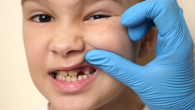 A doctor examines the oral cavity of a child with a missing tooth. Healthcare and dental care concept. Slow motion.