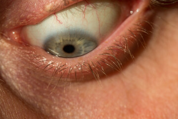 Tired human eye with red capillaries
