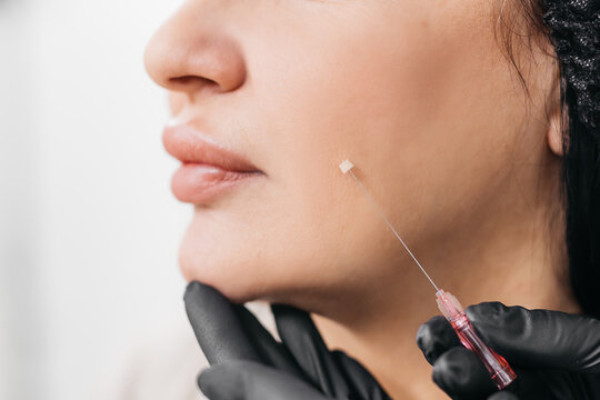 Thread lifting is a cosmetic facial rejuvenation procedure. A cosmetologist implants cosmetic threads under the skin for face lifting and rejuvenation in a modern clinic.