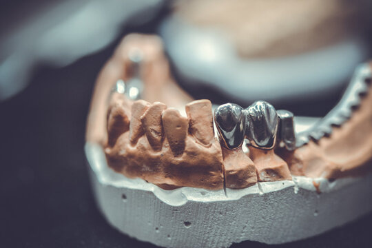 example of a bridge on an artificial human jaw close-up