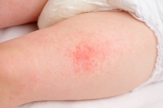 Allergic rash on the legs of the toddler baby boy. Red pimples from allergies on the child's body.