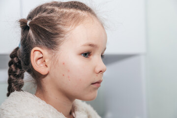 Portrait of a girl in profile with a rash on her cheek from chickenpox. A child suffers from a...