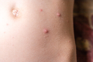 The child has spotted red pimples and a blistering rash from chickenpox or the varicella zoster...