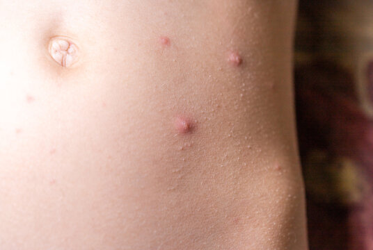 The child has spotted red pimples and a blistering rash from chickenpox or the varicella zoster virus. Viral disease in children. Red pimples all over the body. Infection.
