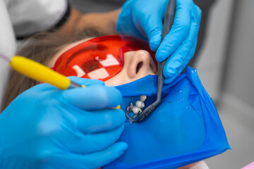 Close-up dentist's hands place the filling material into the patient's tooth with a dental spatula....