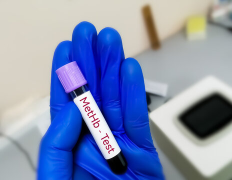 Methemoglobin is a form of hemoglobin, With methemoglobinemia, the hemoglobin can carry oxygen, but is not able to release it effectively to body tissues.