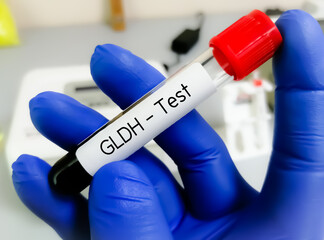 Glutamate dehydrogenase test, GLDH is a mitochondrial enzyme that reversibly converts glutamate to...