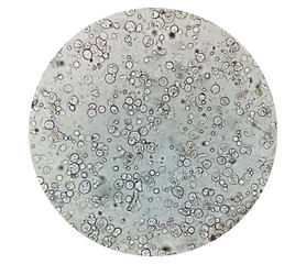 Photomicrograph of urinalysis showing plenty pus cells, urinary tract infection.