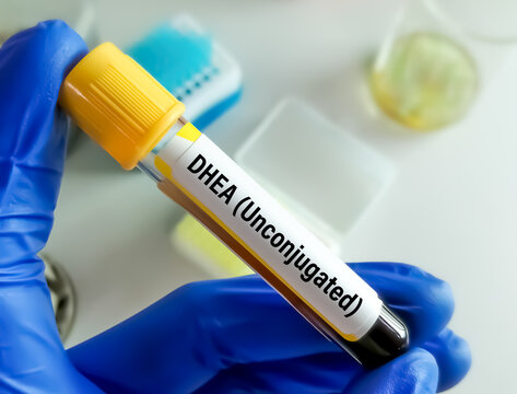 Test Tube with blood sample for DHEA (Unconjugated) hormone test. dehydroepiandrosterone.