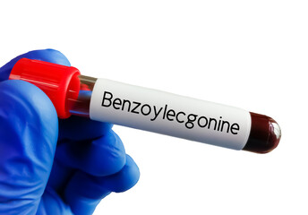 Blood sample for Benzoylecgonine test, it is the major metabolite of cocaine. It is formed by...