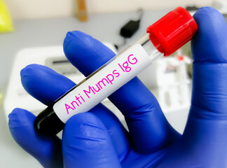 Blood sample for Anti Mumps IgG test. Mumps Antibody.