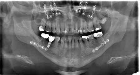 x-ray from a man after orthognathic surgery to correct bite alignment 