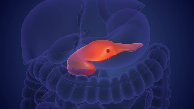 Cancer cell proliferation and injury to the pancreas