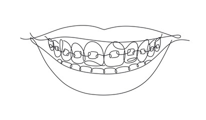 Smile with teeth braces in flat line style drawing on white background