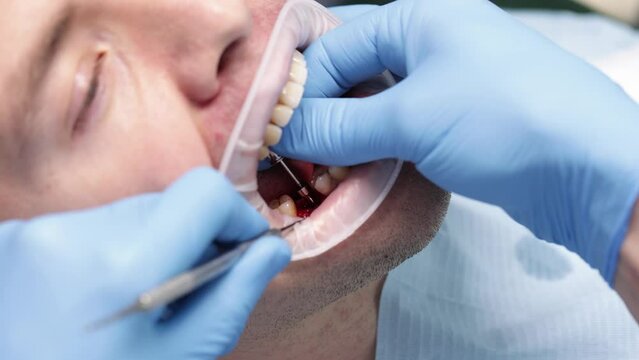 Installing a healing abutment, often referred to as a healing cap or gingival former. Dental implant procedure