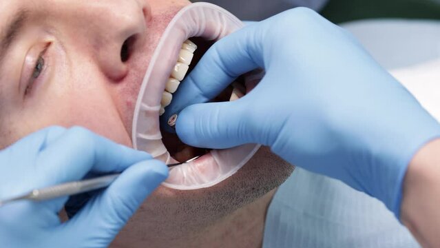Screwing a healing abutment, often referred to as a healing cap or gingival former. Dental implant procedure
