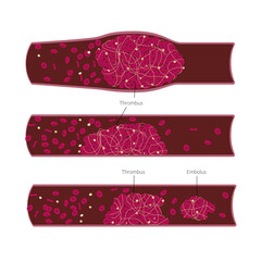 Different types of thrombus and embolus in the blood vessels closup illustration. Medical chart for science or education. Vector illustration - obrazy, fototapety, plakaty