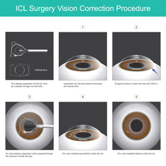 ICL Surgery Vision Correction Procedure. A new eye lens that can be implanted into the eye without removing the natural lens..
