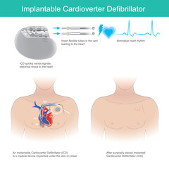 Implantable Cardioverter Defibrillator. Medical tool implanted under the skin use for quickly sends signals electrical shock to the heart. - obrazy, fototapety, plakaty