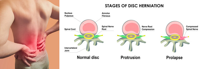 Pain in the spine, man with backache on black background, intervertebral hernia or disc injury concept, Difference between Bulging Disc and Herniated Disc. Stages of Spinal Disc extrusion.