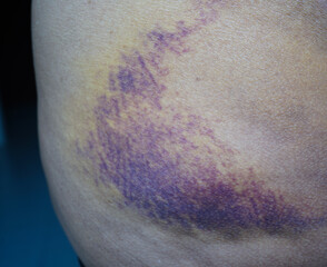 Bruise on the buttock skin injury from accident at home.