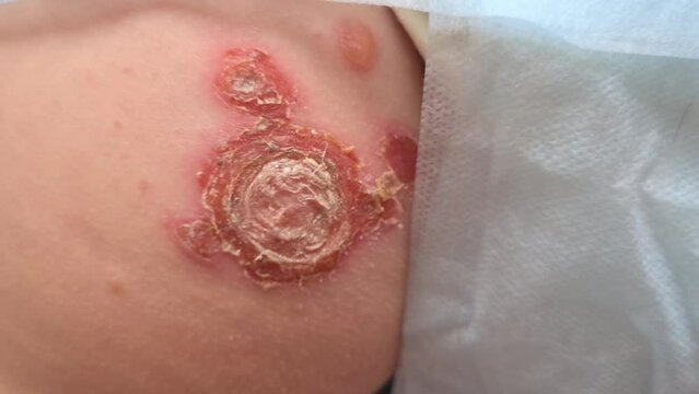 Psoriasis is an autoimmune disease affects skin causing skin to become inflamed and red and scaly. Shingles and herpis