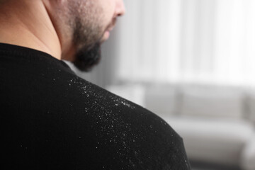Man with dandruff on his sweater indoors, closeup. Space for text - obrazy, fototapety, plakaty
