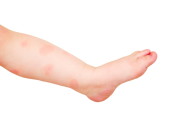 Toddler baby skin care, allergies and dermatitis, isolated on white background. Red spots of allergy and atopic dermatitis on the child skin, isolated white background. Kid aged one year eight months