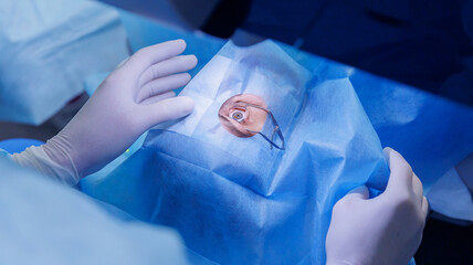 Fototapeta premium Process lasik treatment, laser vision correction. Doctor use equipment for fixing eyeball, patient under sterile cover