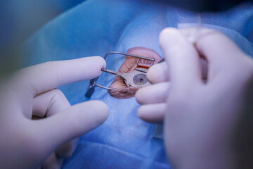 Process laser vision correction, lasik treatment. Doctor use equipment for fixing eyeball, patient...
