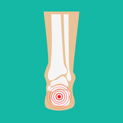 Human leg pain zones. Design elements for infographic. Vector illustration.