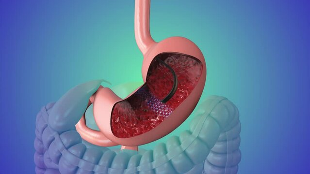 Upper gastrointestinal endoscopy medical animation