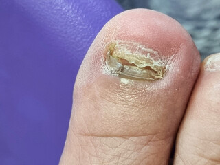 old female healthy foot hurt  by accident toenail need foe medical care. finger yellow cracked hematoma purple color treat disease in hospital
