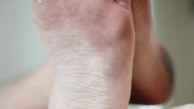 Unhygienic lifestyle of lazy person, stinking dirty feet leading to dermatology infections and fungus problem