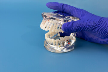Dentist's Hand Holds Study Standard Typodont or Periodontal Disease Teeth Model in Laboratory For...