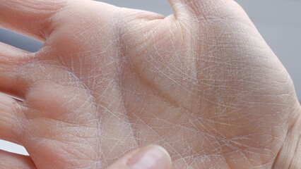 Dry skin on palm close-up side view peeling skin on palm lack of moisture dermatitis cosmetology and dermatology healthcare and medicine hand care, concept of problematic dry skin on palms of hands