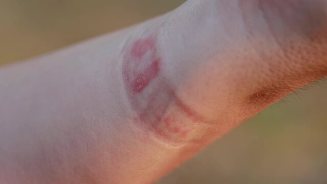 Irritation, redness and itching on the skin after wearing a watch or fitness bracelet. Allergy to watch strap, contact dermatitis, macro. Slow motion