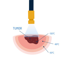 Cryosurgery procedure vector illustration. Medical instrument with cooling liquid nitrogen for tumor treatment. Cryogenic treatment. Removing mole, wart, tumor, cancer.