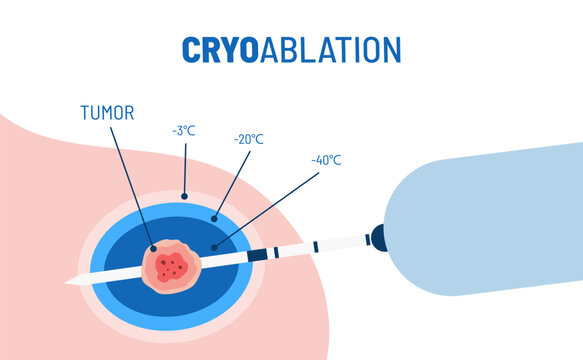 Cryoablation procedure vector illustration. Targeted medical procedure for breast cancer. Minimally invasive tumor treatment. Liquid nitrogen and cryogenic tissue ablation.