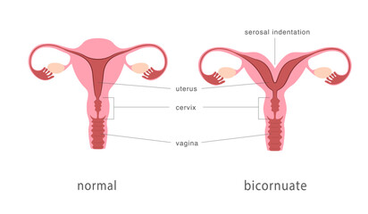 Bicornuate and normal human uterus structure. Uterine deep septum as a congenital uterine malformation. Anatomy chart. Vector illustration