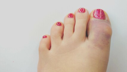 Naklejka premium contusion of the big toe, tram, bruise, cracked