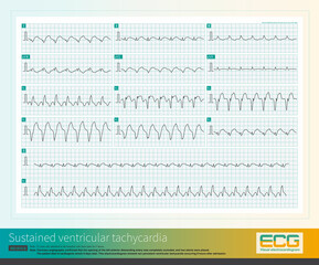 When ventricular premature contractions originate from the left ventricle, the QRS wave in lead V1 is often qR wave or notch R wave, which can be misdiagnosed as complete right bundle branch block. - obrazy, fototapety, plakaty
