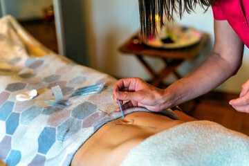 Young woman undergoing acupuncture treatment on her stomach, closeup - obrazy, fototapety, plakaty