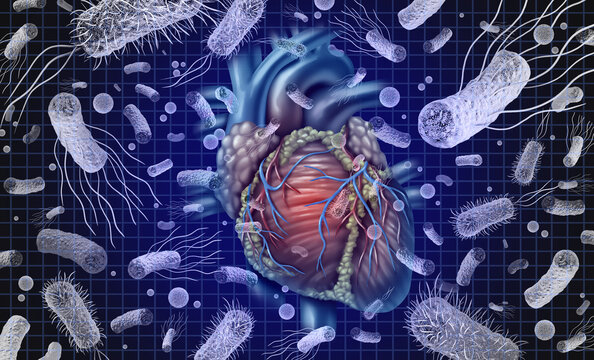 Bacterial Endocarditis or Heart And Bacteria and septicemia or sepsis as blood poisoning due to germs.