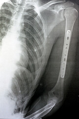 Plain x ray showing transverse midshaft left humerus fracture caused by a direct trauma in a car...
