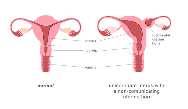 Normal human uterus and unicornuate uterus with non-comunicating uterine horn. Congenital uterine malformation anatomy diagram.
